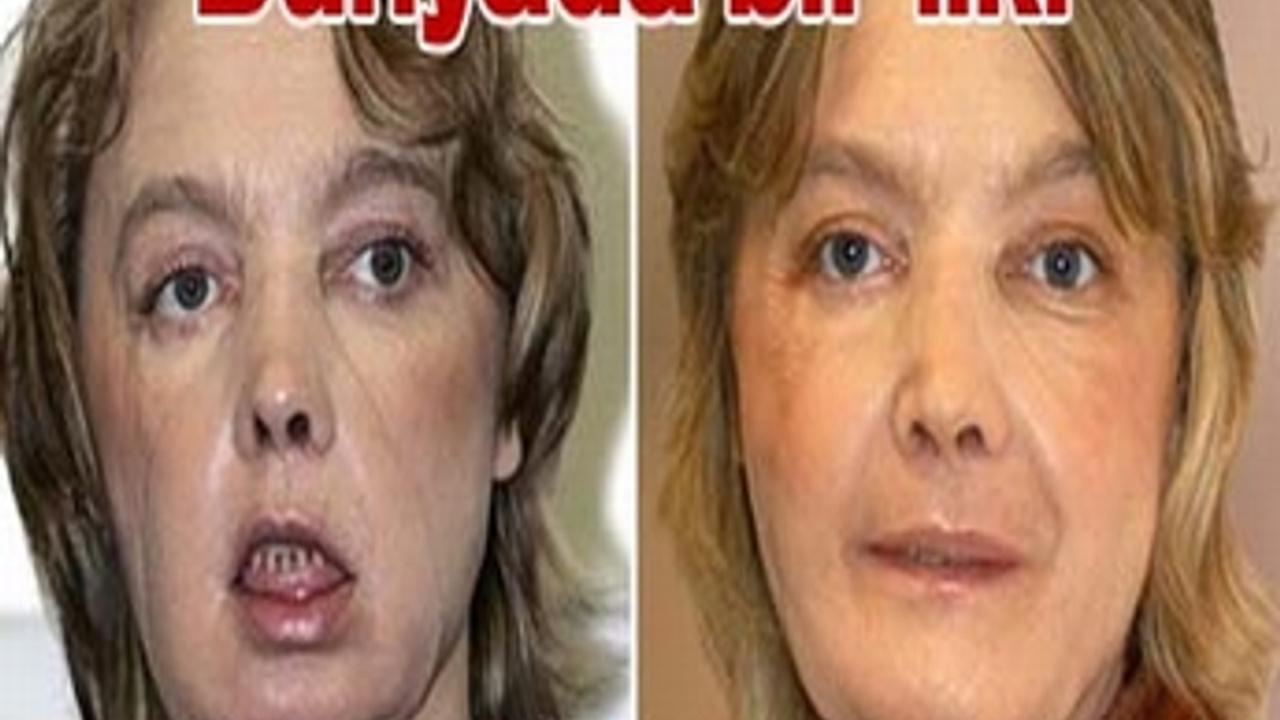 Facial first picture transplant