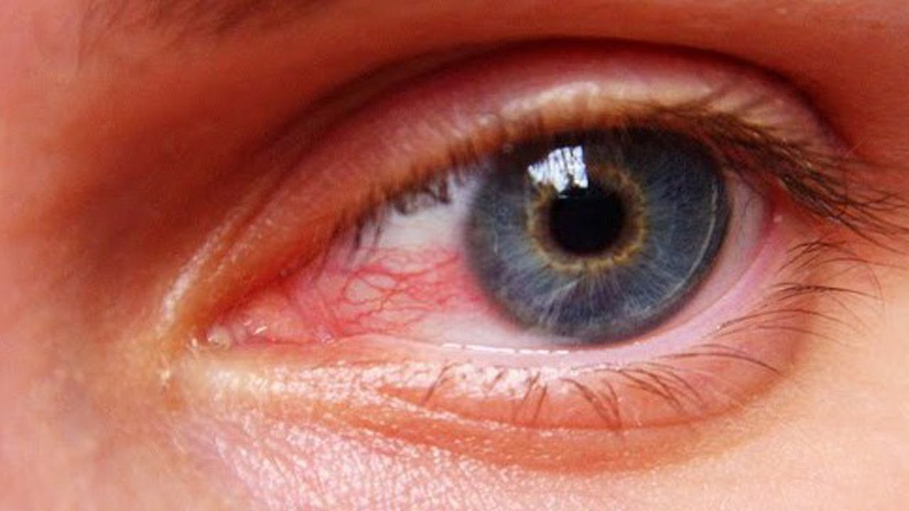Пелена на глазах какие. Авитаминозный кератит. Конъюнктивит герпетический кератит.