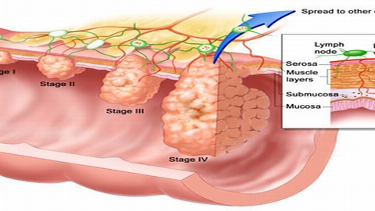 Термальная стадия онкологии кишечника