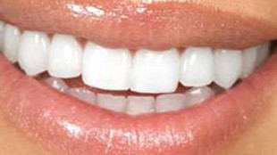 Protez diş nedir, niçin yapılır?