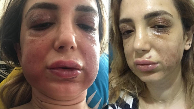Genç kadın estetik mağduru oldu