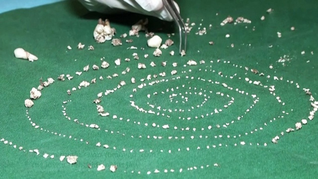 Küçük çocuğun ağzından 526 diş çıkarıldı