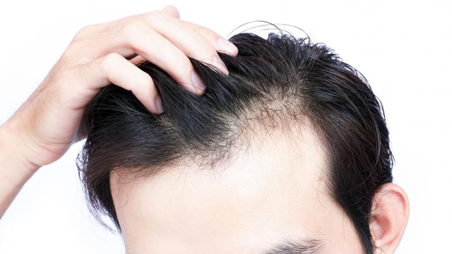 Hormonal değişiklikler saçları dökebiliyor